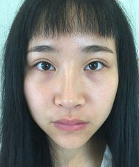 M唇术后100天效果满意100分+【变美日记】