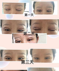 ����˫��Ƥ��Ҳ����ʹ�����۾���+�������ռǡ�