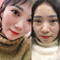 没了眼袋仿佛年轻十岁