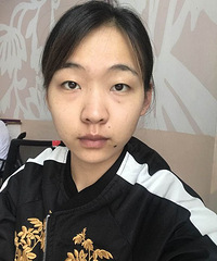 做了双眼皮后改变好大,整个人都灵气了很多