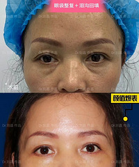 成都去眼袋,刘晶医生:去眼袋手术有什么坏处/去眼袋手术的弊端
