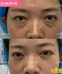 成都哪里去眼袋好?刘晶:为什么有人做了去眼袋手术反而更显老?