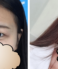 成都市双眼皮案例,刘晶:做双眼皮术后饮食需要注意什么