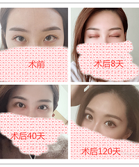 成都双眼皮手术,刘晶医生:单眼皮割双眼皮哪种手术方法好?