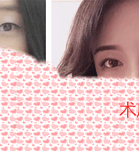 成都 韩式双眼皮的优势有哪些?成都刘晶整形介绍