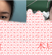 成都做双眼皮推荐医生,成都刘晶介绍:双眼皮术后“养护”注意事