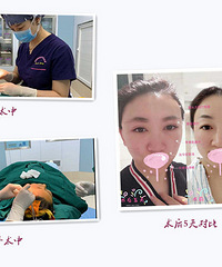 成都面部提升手术,2019你也可以变得年轻