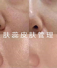 成都小气泡清洁皮肤,肤蕊皮肤管理:小气泡多久做一次比较好?