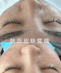春节过后,成都好多美女都去做小气泡了,哪些人不适合做小气泡