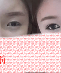 成都|什么样的双眼皮手术能够达到闭眼无痕的效果呢?