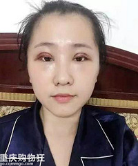 做了双眼皮手术,比对之前的照片,改变太大了