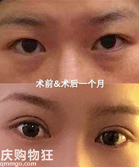 做双眼皮一个月了!看看对比照,真的感觉好惊讶