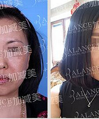 穆宝安做面部提升好不好