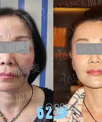 V美减龄,打造面部提升焕颜新境界