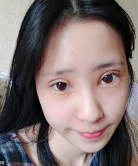 做了双眼皮手术2周后,朋友都夸我的眼睛好漂亮