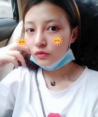 做了隆鼻之后,我的五官轮廓感觉更协调了