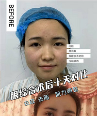 成都割双眼皮,整形刘晶割双眼皮 ,打造电眼魅惑