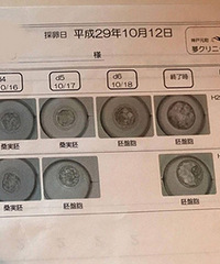 日本试管婴儿一次成功