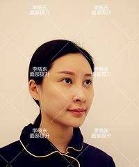 线雕,什么是线雕手术