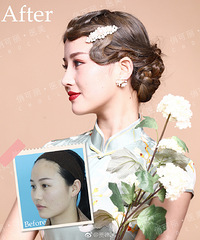 成都膨体隆鼻,贾德渊隆鼻