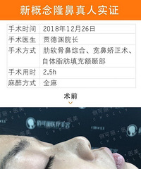 成都鼻综合的医生排名,贾德渊隆鼻恢复过程