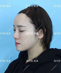 在成都隆鼻术后1月效果分享,贾德渊隆鼻反馈