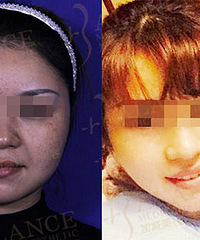 穆宝安面部提升怎么样,V美减龄重塑青春