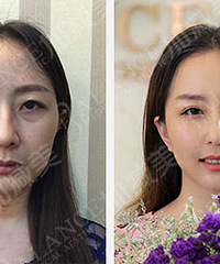 穆宝安V美减龄面部提升1小时减龄15岁