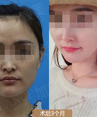 穆宝安V美减龄迅速恢复青春态