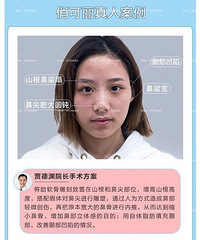 成都肋软骨隆鼻,贾德渊做肋软骨隆鼻好看吗