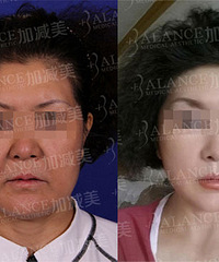 穆宝安面部提升效果如何迅速减龄十岁