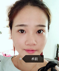 隆鼻8个月后我变成这样,诠释一个部位拯救一张脸