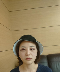 双眼皮修复成功的我,来给大家参考一下