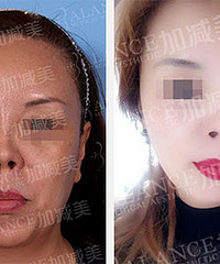北京加减美穆宝安V美减龄面部提升为你加固青春