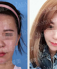 穆宝安终结大拉皮时代 V美减龄成为面部提升技术王者