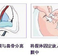 昆明做隆鼻手术哪家医院好