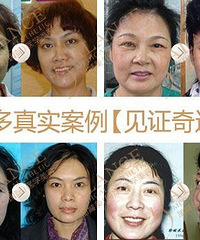 穆宝安做面部提升技术好不好,V美减龄重拾青春容颜