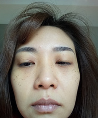 脸太凹真的很显老!做了自体脂肪填充,变年轻好多