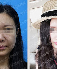 穆宝安V美减龄术后怎么护理?