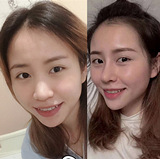 这就是隆鼻15天的效果