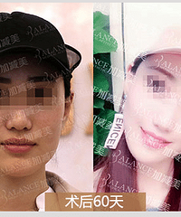 加减美:想要精致的瓜子脸吗?