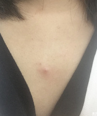 前胸后背总是长痘痘,来说说你是怎么解决的