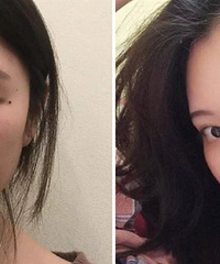 鼻基础再差也能做出好看的鼻子!手术后很自然