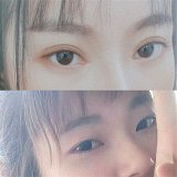 狐狸眼变成大双眼皮