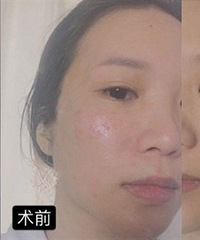 超详细的心得体会告诉你线雕是不是真的有用!反正我的脸更精致了