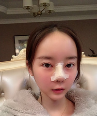隆鼻半年之后,没有精心护理,也恢复得很好!