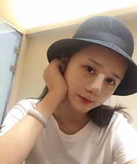 隆鼻恢复一个月就不痛不肿,变得很自然了