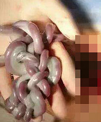 后怕!肚皮发紧,胎动厉害,原来是胎儿把脐带绕成了“中国结”
