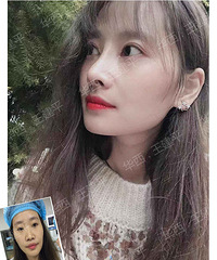成都隆鼻哪家好?华西王建平隆鼻案例哪有