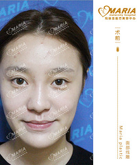 成都脸部埋线提升,哪家医院好,面部提升案例哪有